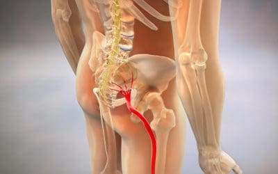 Understanding Sciatica: How Chiropractic Care Can Offer Relief